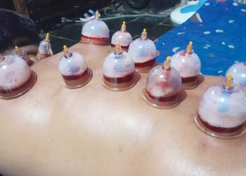 Saat Puasa Badan Sakit, Apakah Boleh Bekam, Berikut Pendapat 3 Ulama Soal Ini