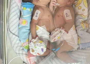 Kondisi Kesehatan Bayi Kembar Siam Cirebon Stabil, Dipantauan Tim Kesehatan Puskesmas hingga RS