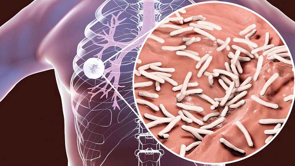 Kasus TBC di Kabupaten Cirebon masih Tinggi